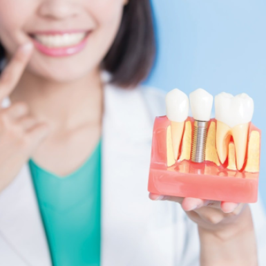 Phục hình implant